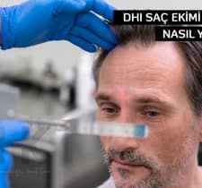 Dhi Saç Ekimi Nedir ? Nasıl Yapılır ?