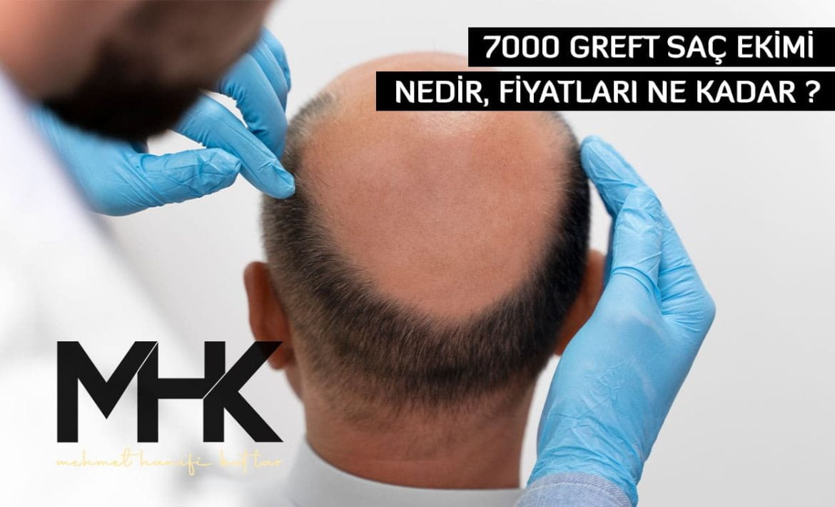 7000 Greft Saç Ekimi