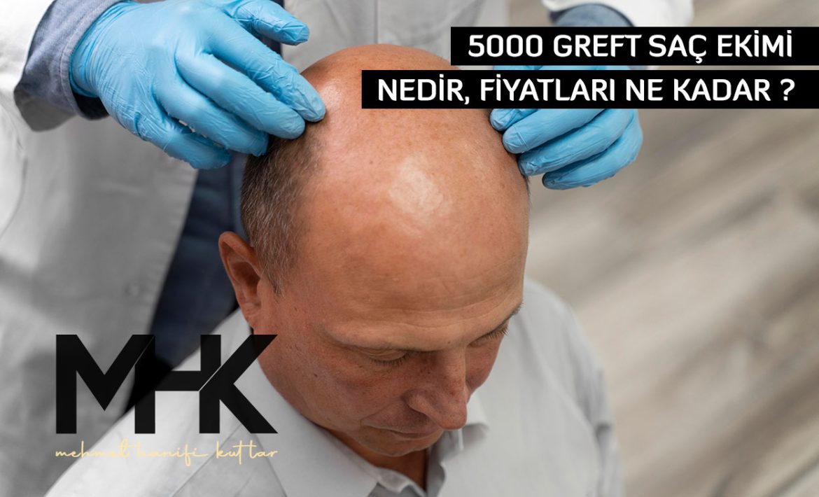 5000 Greft Saç Ekimi