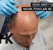 5000 Greft Saç Ekimi