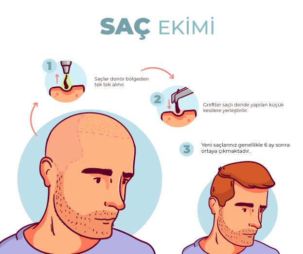 4000 Greft Saç Ekimi