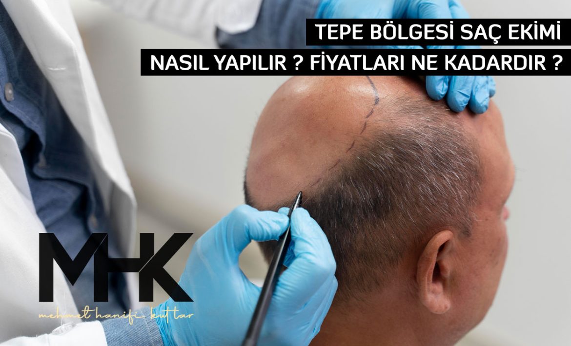 Tepe Bölgesi Saç Ekimi