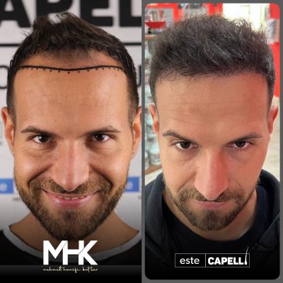 Saç Ekimi Öncesi Sonrası