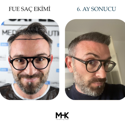 Öncesi Sonrası