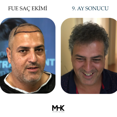 Öncesi Sonrası